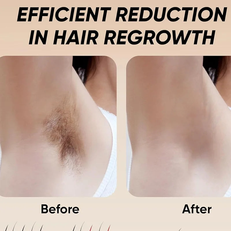 IPL Hair Removal Handset