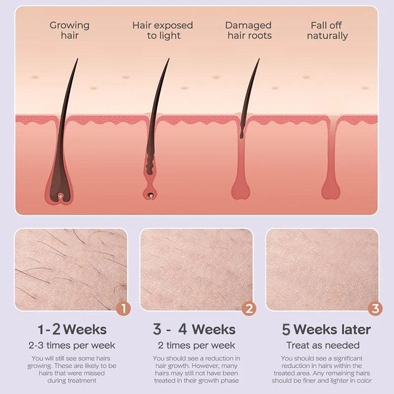 IPL Hair Removal Handset